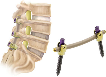 Vertebral bone ossification using polyether ether ketone (PEEK)