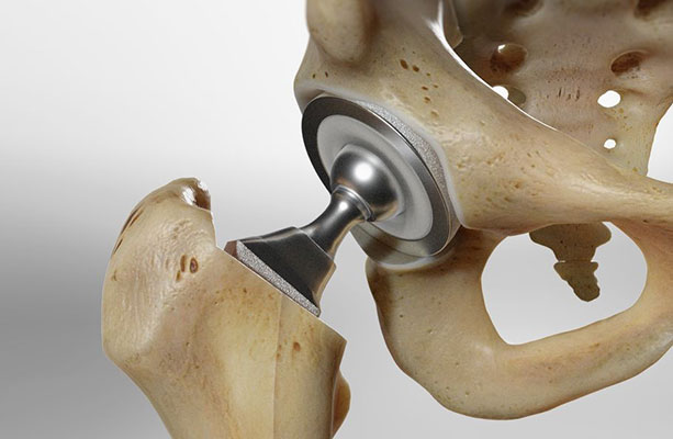 bone joint connection - Polymers in Medicine